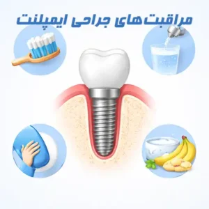 مراقبت های بعد از ایمپلنت
