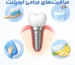 مراقبت های بعد از ایمپلنت